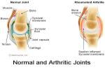 Normal & Arthritic Joints
